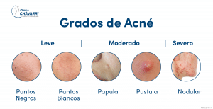 Acne Infectado ¿Cómo saber que tipo de acné tengo? | Clínica Chávarri