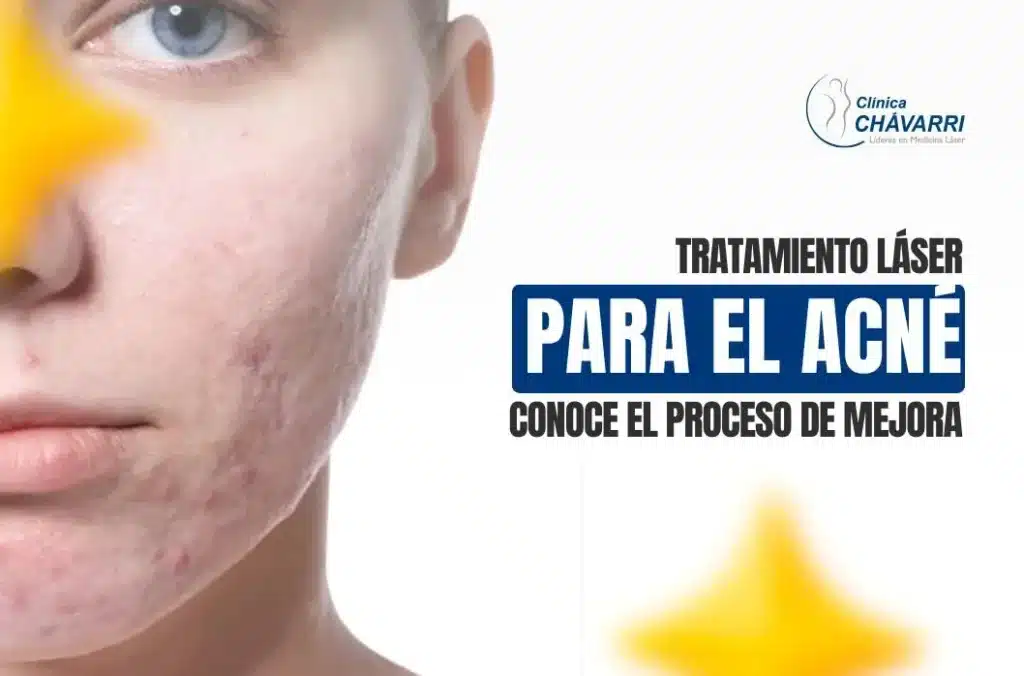 tratamiento-laser-para-acne-proceso