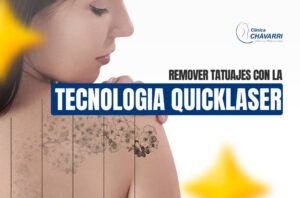 remover-tatuajes-con-tecnologia-quicklaser