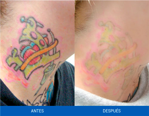 remover-tatuajes-quicklaser-resultados-1