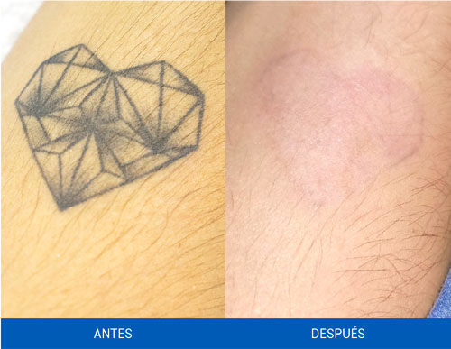 remover-tatuajes-quicklaser-resultados-2