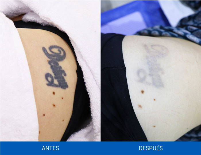 remover-tatuajes-quicklaser-resultados-3