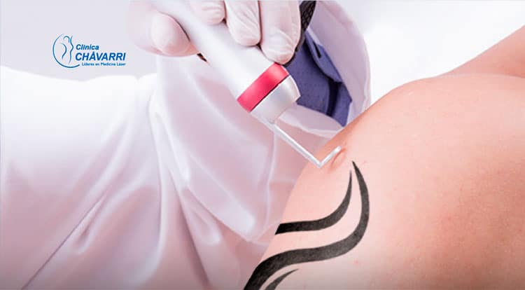 ventajas-tratamiento-quicklaser-tatuajes