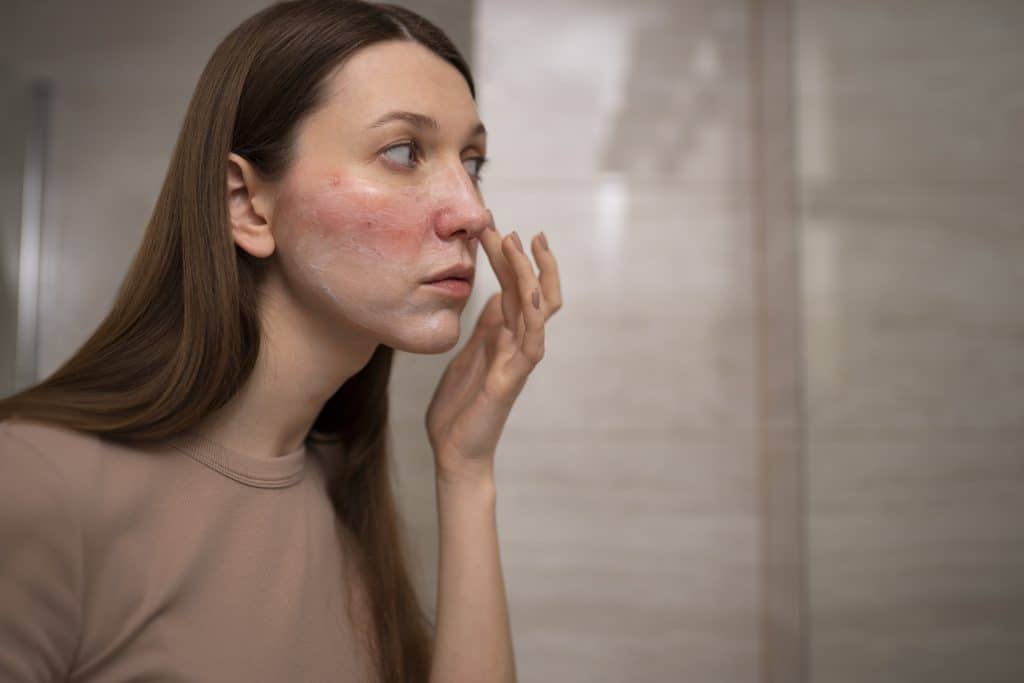 rosacea-entendiendo-y-tratando-el-enrojecimiento-facial/