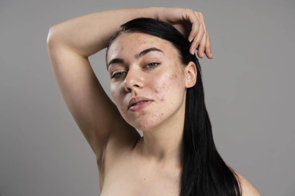 secuelas-de-acne-entendiendo-el-problema-y-explorando-soluciones/