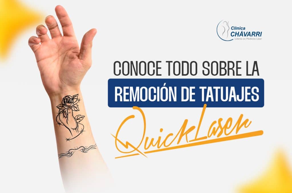 quicklaser para eliminar tatuajes no deseados