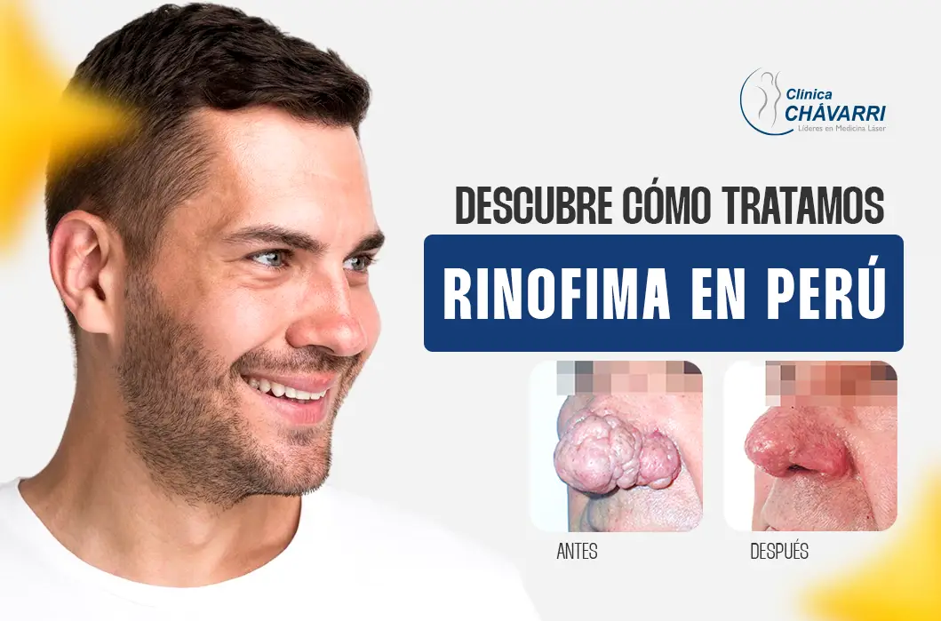 Los Tratamientos para Rinofima en el Perú