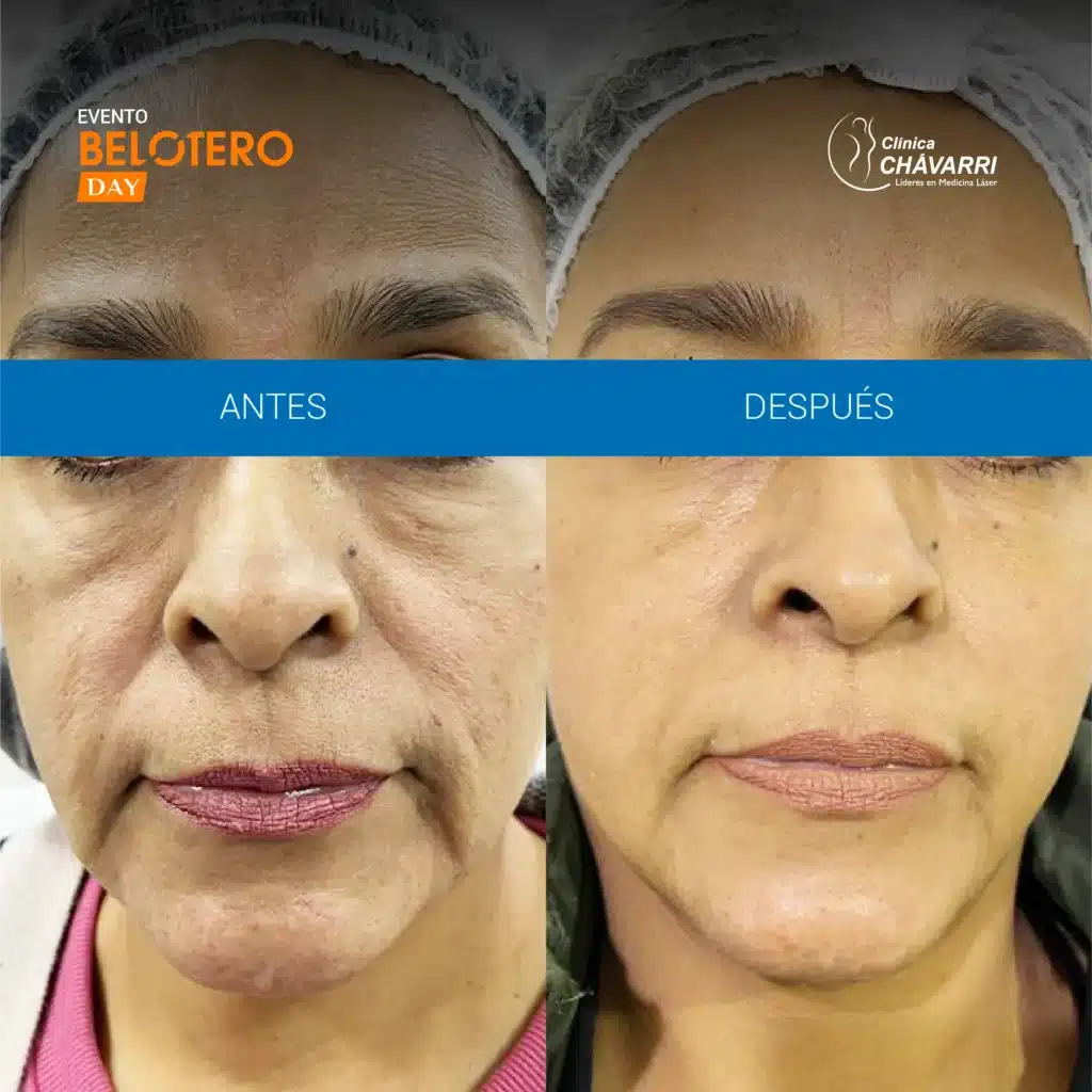 AYD ARMONIZACIÓN FACIAL BELOTERO DAY-1