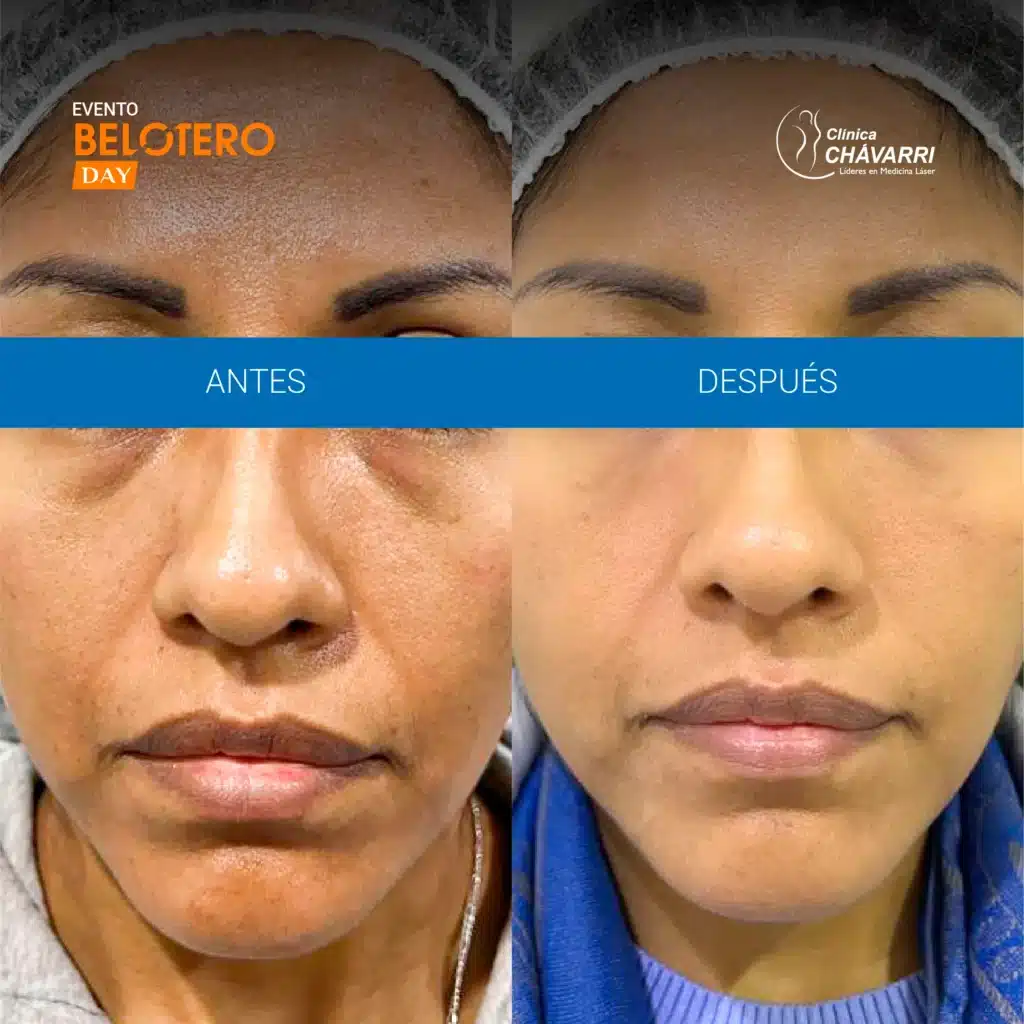 AYD ATENUACION DE OJERAS BELOTERO DAY-2