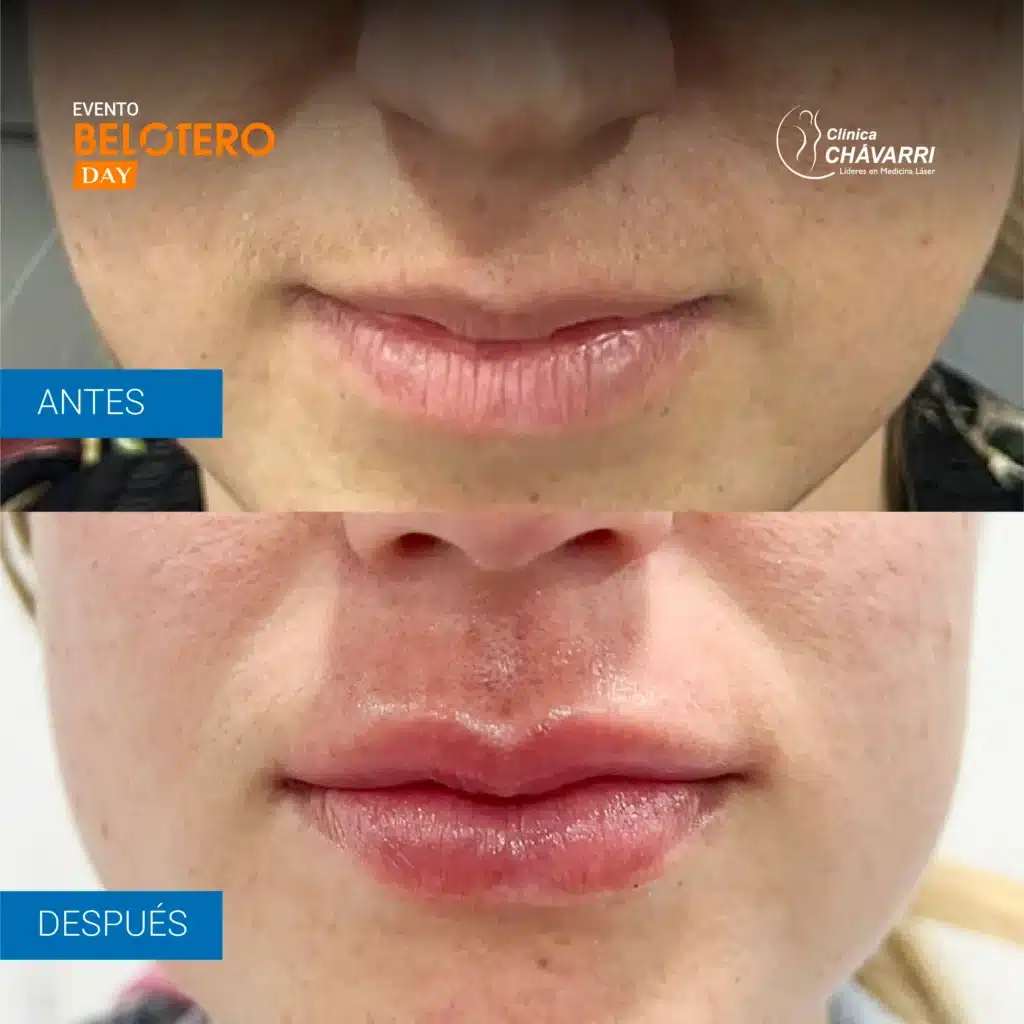 AYD AUMENTO DE LABIOS BELOTERO DAY-1