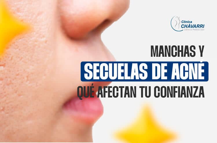 manchas-secuelas-acne-afectan