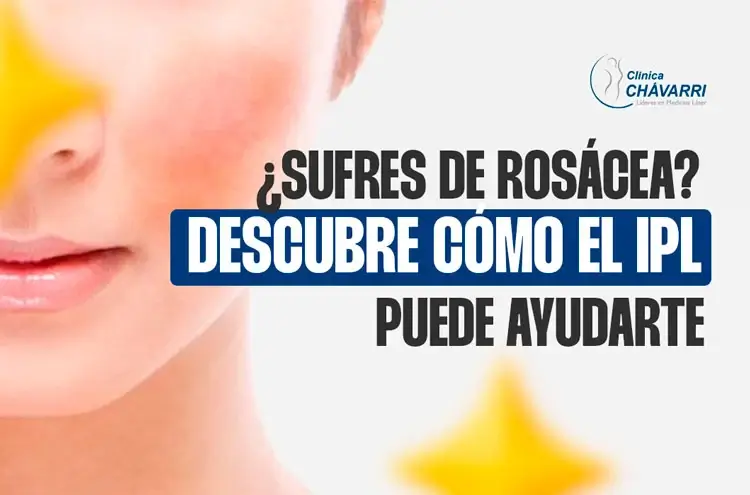 rosacea-tratamiento-laser-ipl