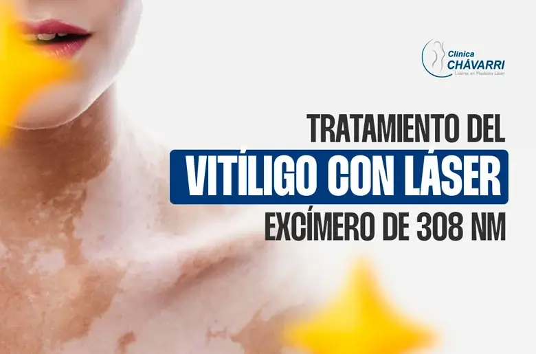 tratamiento-vitiligo-laser-excimero