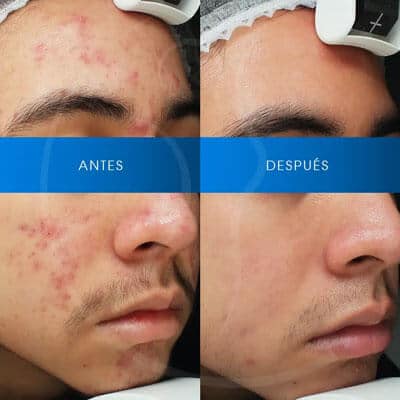 antes-despues-co-chavarri-2