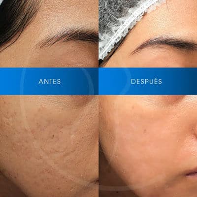 antes-despues-laser-co2-chavarri-3