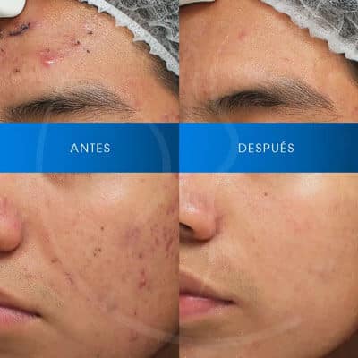 antes-despues-laser-co2-chavarri