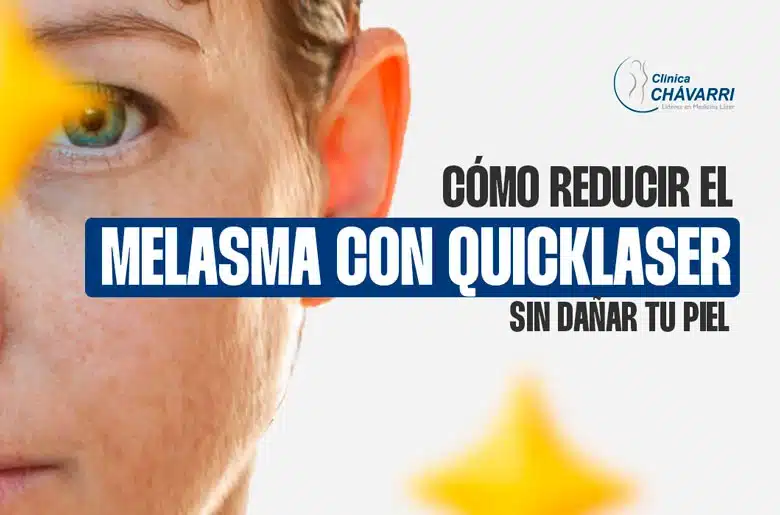 melasma-con-quicklaser