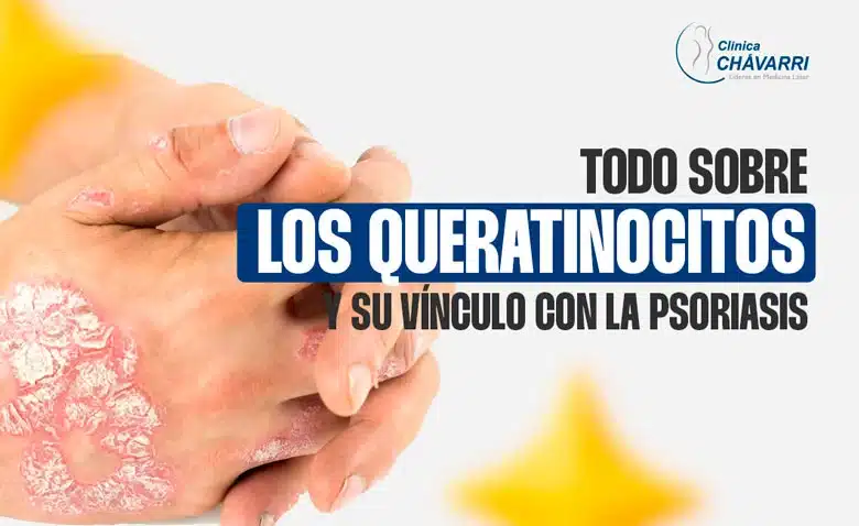 Todo sobre los Queratinocitos y su vínculo con la psoriasis