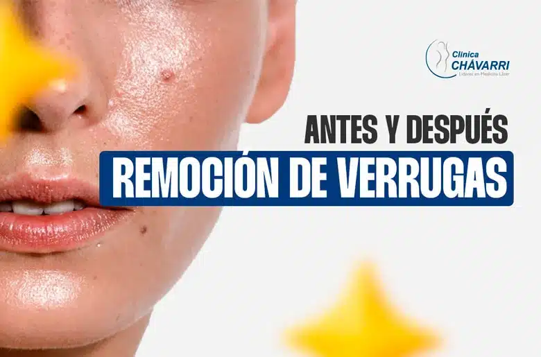 Remoción de verrugas: Antes y Después