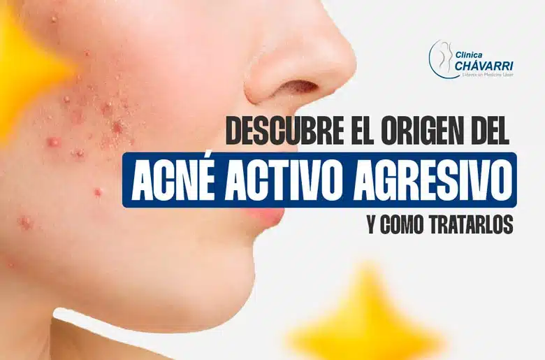 Origen del acné activo agresivo y cómo tratarlo de forma efectiva