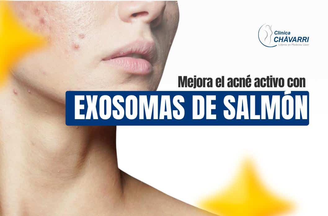 tratamiento-acne-exosomas-salmon