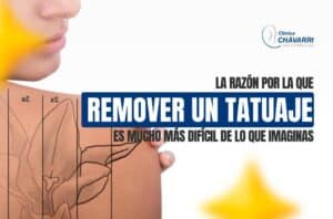 eliminar-un-tatuaje-con-laser