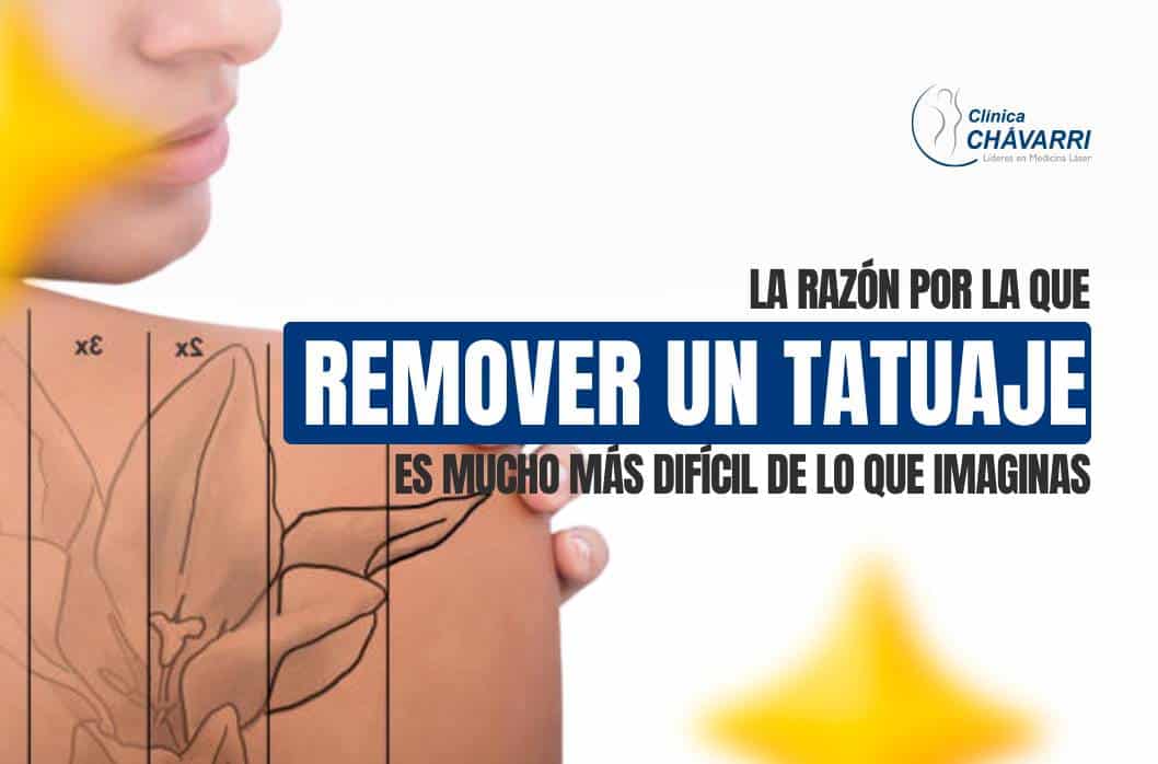 eliminar-un-tatuaje-con-laser
