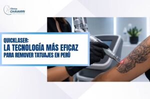 quicklaser-tecnologia-para-remover-tatuajes