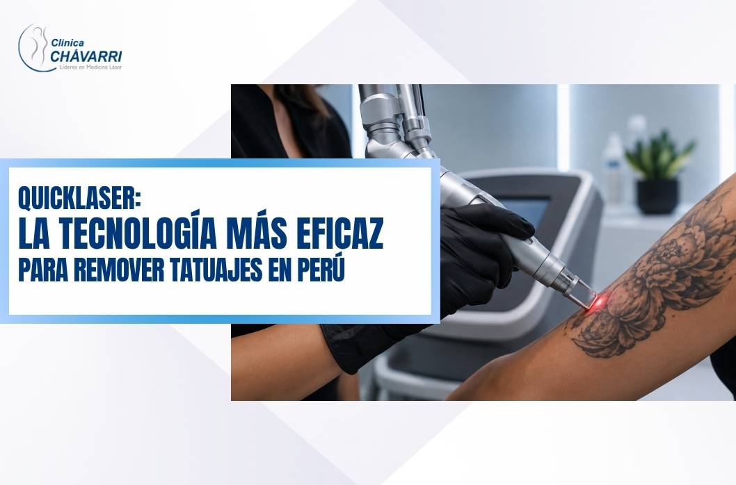quicklaser-tecnologia-para-remover-tatuajes