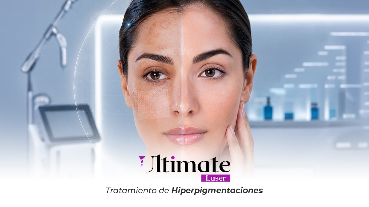 Tratamiento de Hiperpigmentaciones con Ultimate Laser de Clínica Chávarri