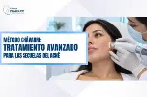 metodo-chavarri-tratamiento-avanzado-secuelas-acne