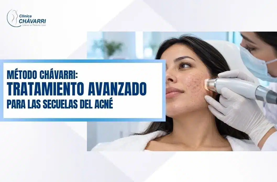 metodo-chavarri-tratamiento-avanzado-secuelas-acne
