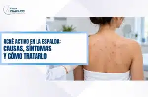 acne-activo-en-la-espalda