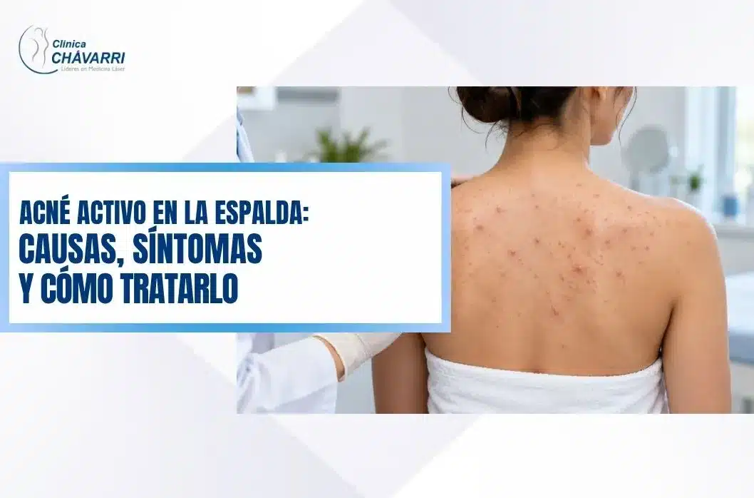 acne-activo-en-la-espalda